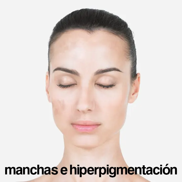 mesoestetic manchas e hiperpigmentación