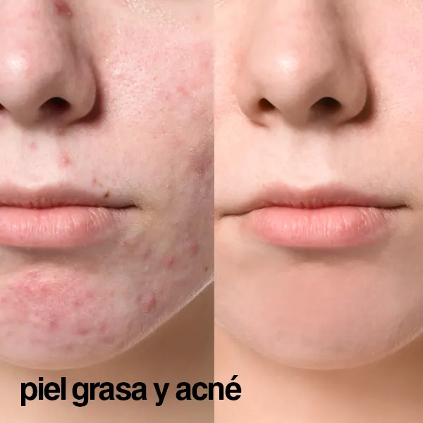 mesoestetic piel grasa y acné