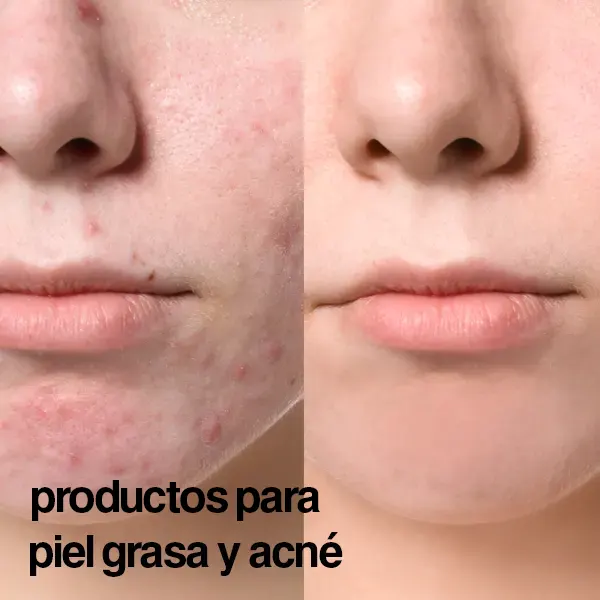 productos para piel grasa y acné